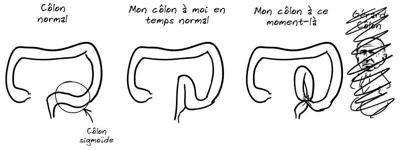 Côte à côte, on voit un côlon normal, avec le sigmoïde qui est la dernière partie qui remonte légèrement avec le rectum, mon côlon à moi en temps normal, avec le sigmoïde beaucoup plus long et qui remonte beaucoup, et mon côlon à ce moment-là, avec le sigmoïde qui est replié sur lui-même et fait une boucle. À côté, barré, Gérard Côlon.