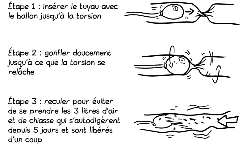 Étape 1 : insérer le tuyau avec le ballon jusqu'à la torsion / Étape 2 : gonfler doucement jusqu'à ce que la torsion se relâche / Étape 3 : reculer pour éviter de se prendre les 3 litres d'air et de chiasse qui s'autodigèrent depuis 5 jours et sont libérés d'un coup