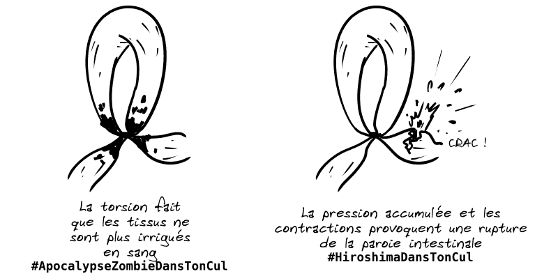 A. La nécrose : la torsion fait que les tissus ne sont plus irrigués en sang #ApocalypseZombieDansTonCul / B. La fissure : la pression accumulée et les contractions provoquent une rupture de la paroie intestinale #HiroshimaDansTonCul